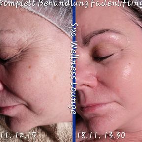 JM Derma Kosmetik_Fadenlifting ohne Nadeln